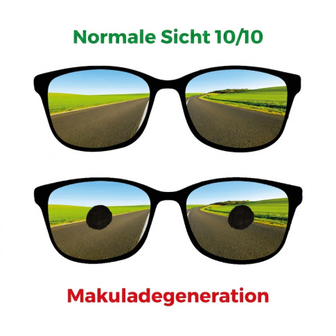 Brille zur Simulation einer Makuladegeneration bei 6/120